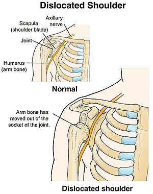 Anatomy of a Dislocated Shoulder.