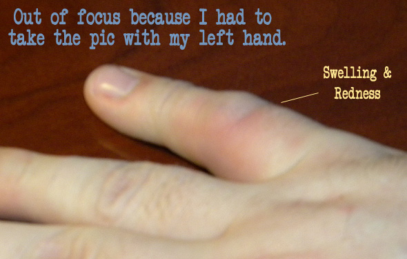 Dislocated finger