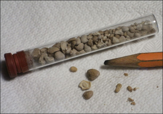 some of my kidney stone